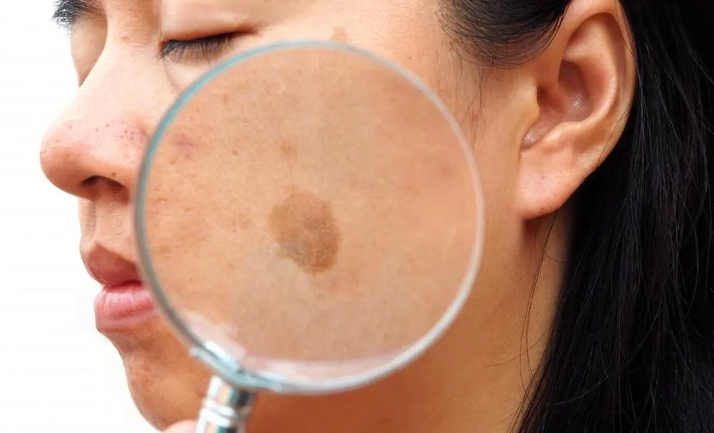 How Seborrheic Keratosis Bedford appears on the skin Bedford