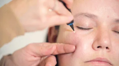 CryoPen device treating milia Bedford cysts on the skin safely and precisely Bedford
