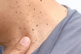 Seborrheic Keratosis: Understanding Skin Changes and CryoPen Treatment Options Bedford