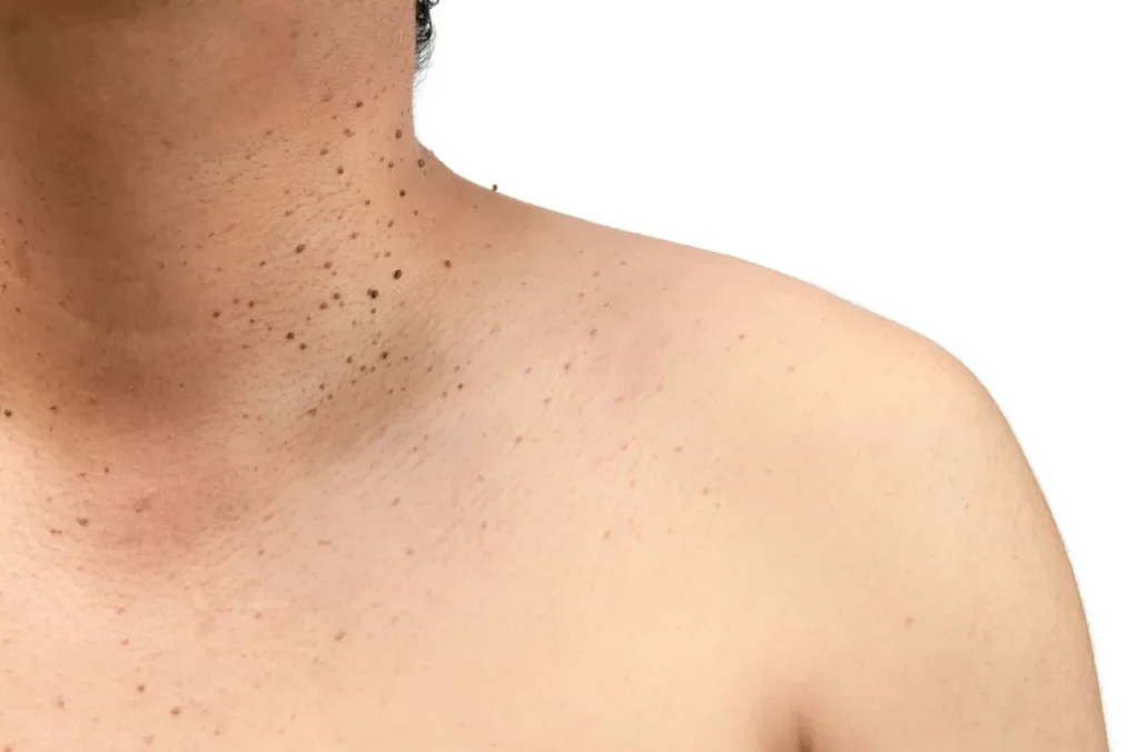 How to Maintain Healthy Skin After Treatment Bedford? Bedford
