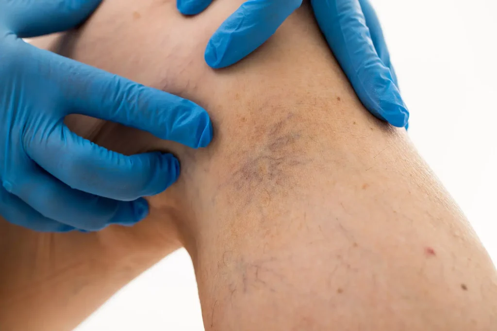 Spider Veins vs. Spider Angiomas: Understanding the Differences in CryoPen Bedford