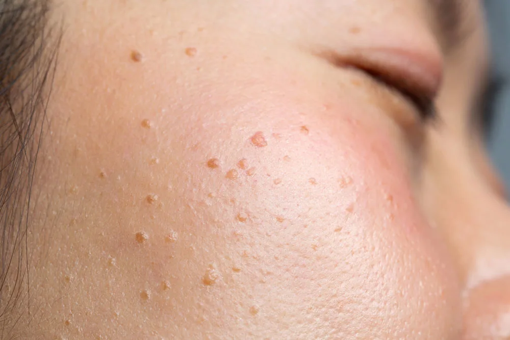 Why Choose CryoPen for Seborrheic Keratosis Bedford Bedford