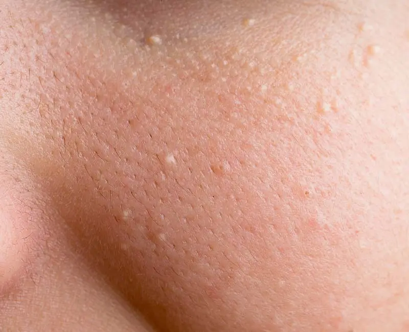 Milia keratin-filled cysts treated with CryoPen for safe scar-free removal Bedford