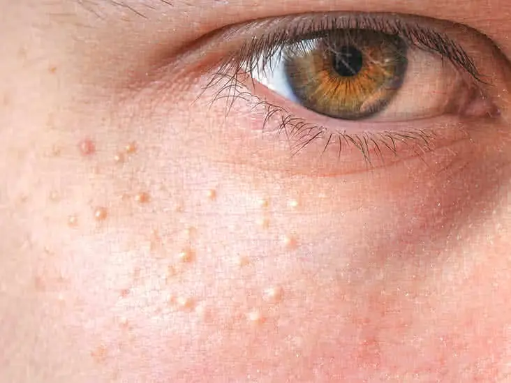 Close-up of skin showing milia Bedford, small keratin-filled cysts on the face Bedford